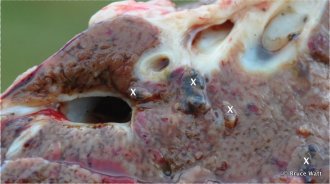 Figure 2. Mature fluke (shown with X) within and exuding from fibrosed ('thickened') bile ducts.