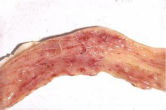 Image: Colon with large-mouthed bowel - Chabertia (Source: Prof Nick Sangster, University of Sydney)