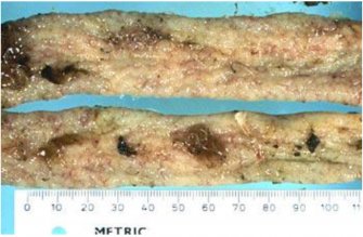 Image: Whipworm - Trichuris in the caecum/large bowel of a sheep (Source: Dr R  Woodgate, Department of Agriculture Western Australia)